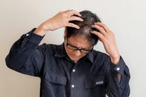 薄毛・脱毛・AGA・FAGA